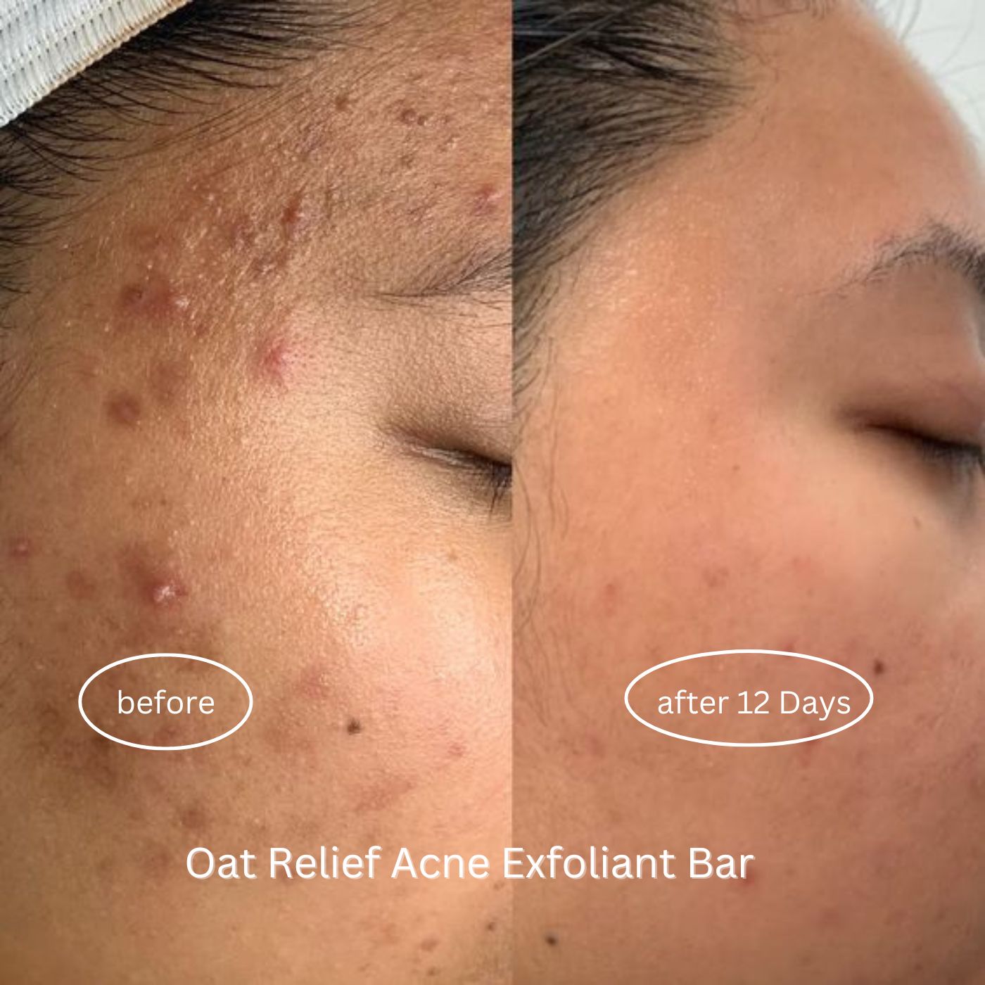 Oat Relief Acne Exfoliant