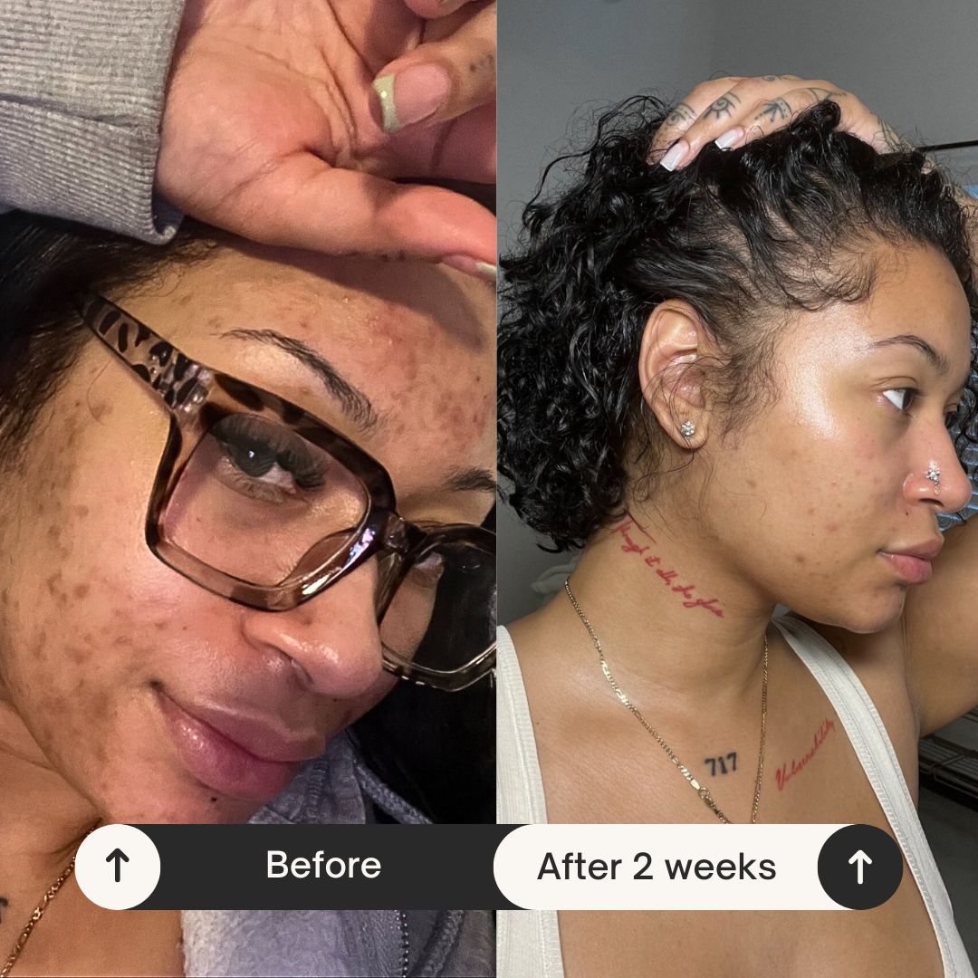 2IN1 DOUBLE CLEANSING BAR | ACNE RELIEF | DISCOLORATION CORRECTOR