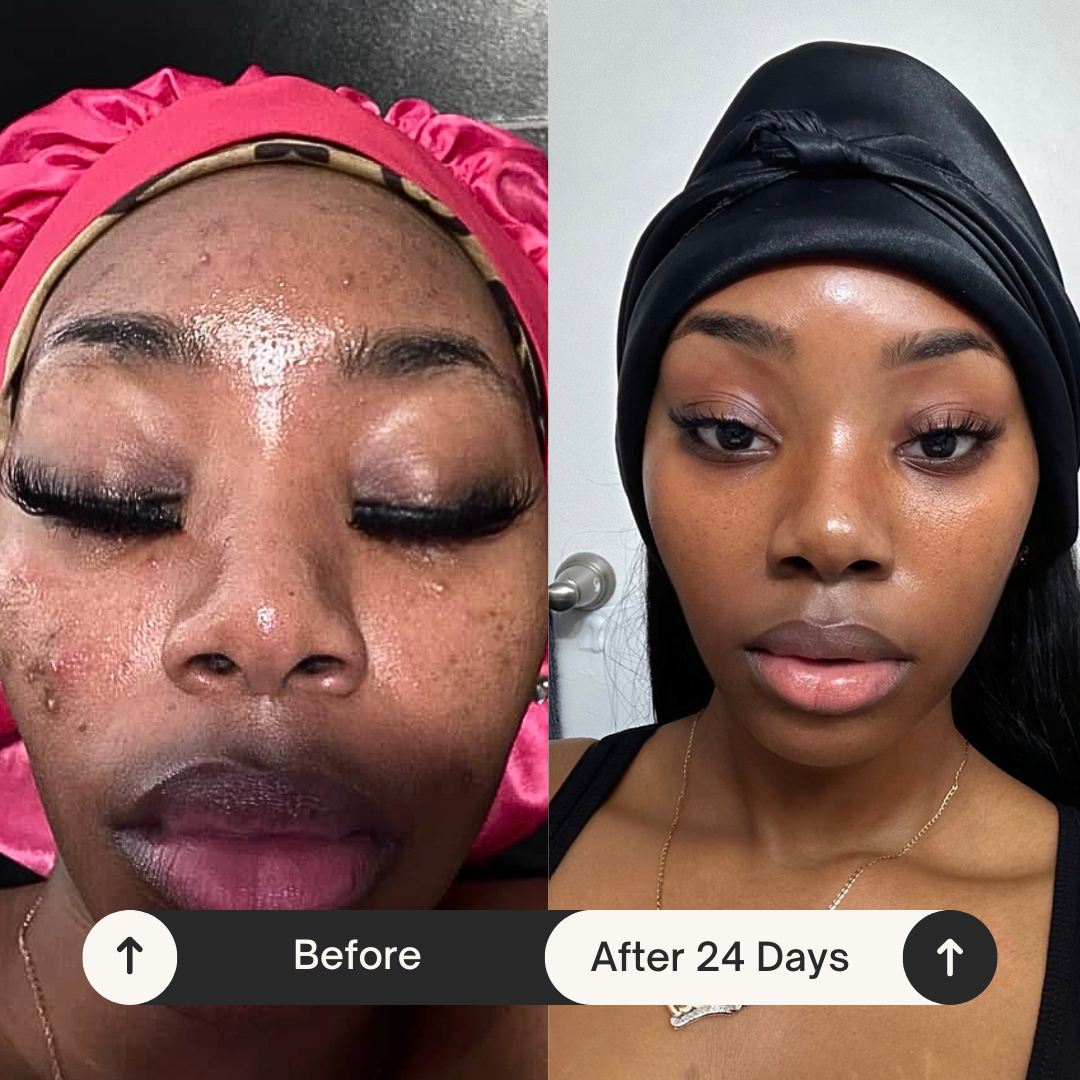 2IN1 DOUBLE CLEANSING BAR | ACNE RELIEF | DISCOLORATION CORRECTOR