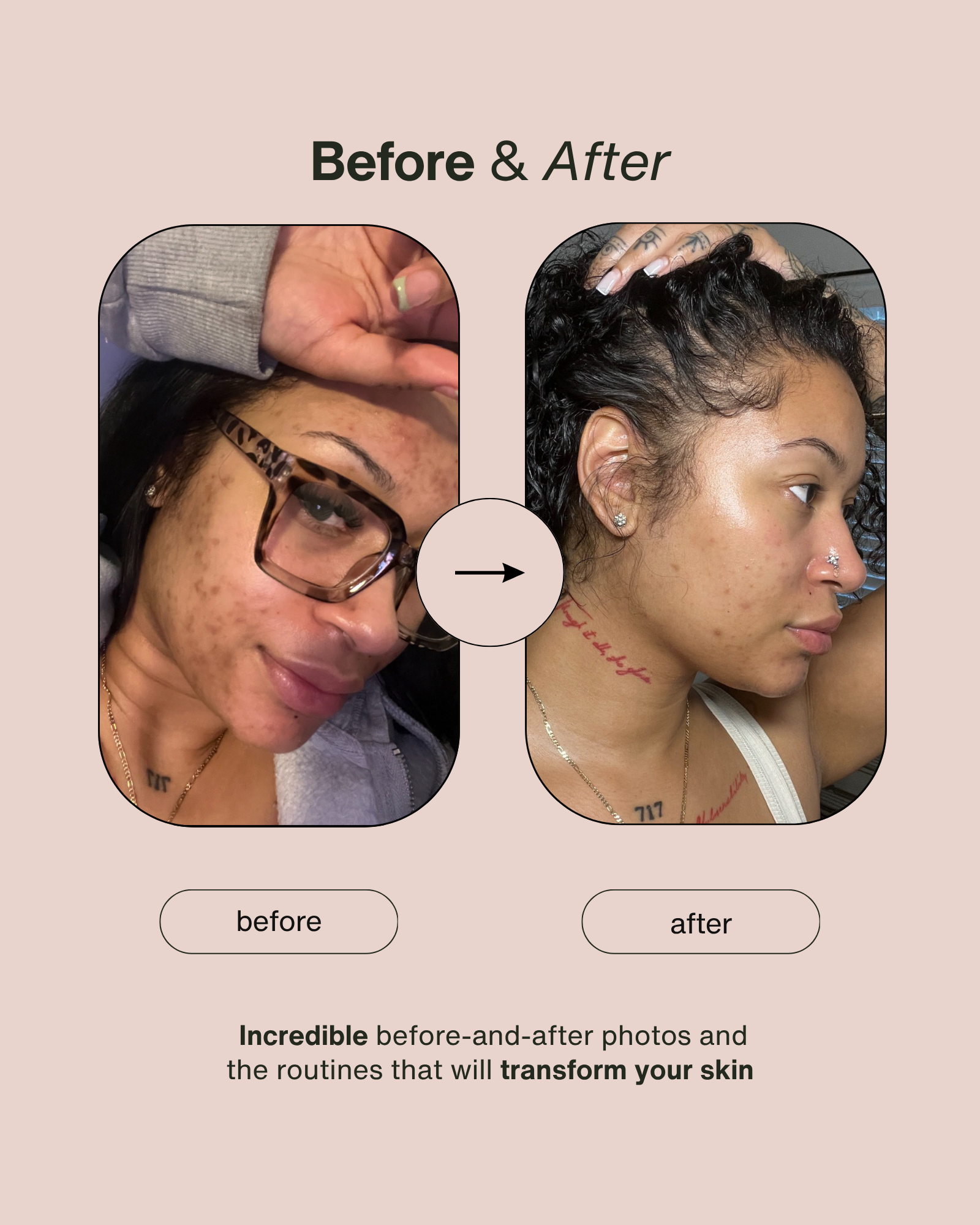 2-1 ACNE & DARK SPOT CORRECTING CLEANSER