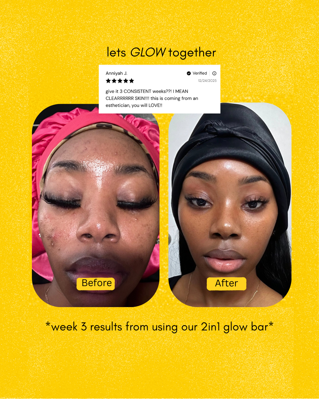 2-1 GLOW BAR - Acne & Darkspots