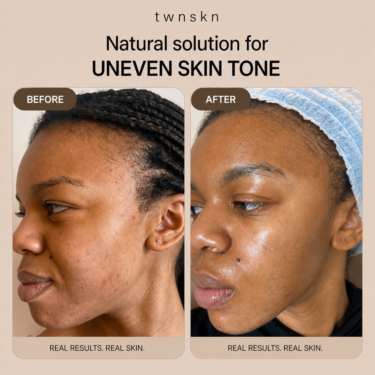 Glass skin kit